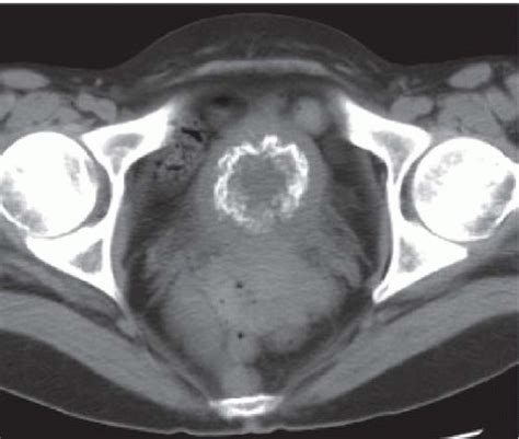 The Urinary Bladder Radiology Key