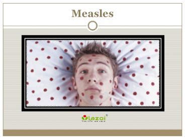 Ppt Measles Causes Symptoms Complications And Treatment