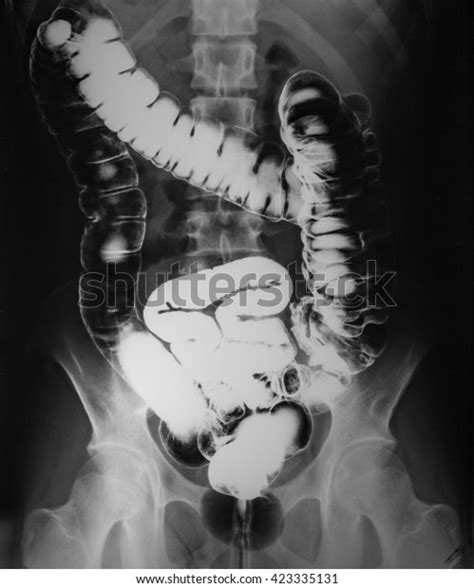 Xray Image Plain Abdomen Colon Stock Photo Shutterstock