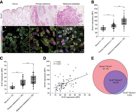 Expression Of Dna Methyltransferase 1 Is A Hallmark Of Melanoma