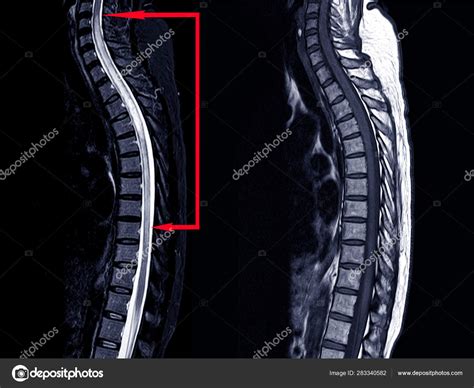 Mri Van Thoracische Wervelkolom Geschiedenis Een 53 Jarige Vrouw