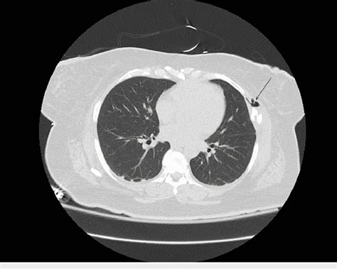 Computed Tomography Without Contrast Of The Chest In Transverse View