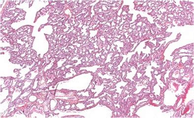 Fetal Lung Interstitial Tumor Case Histology Shows Diffuse