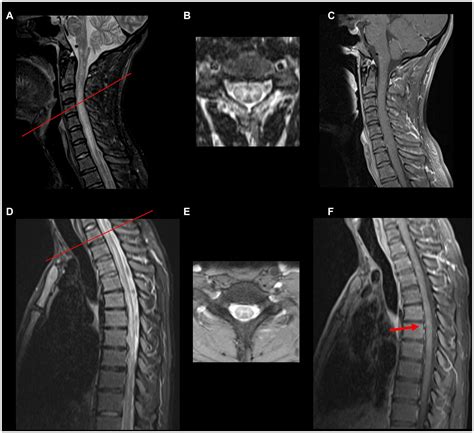 Frontiers Transverse Myelitis In Myelin Oligodendrocyte Glycoprotein