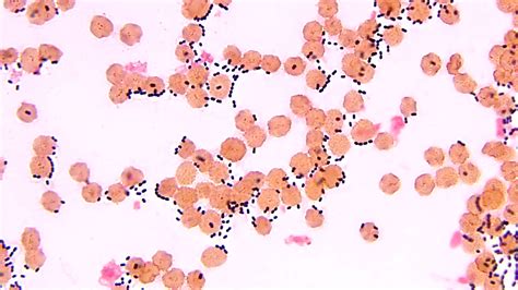 Pathology Outlines Streptococcus Pneumoniae