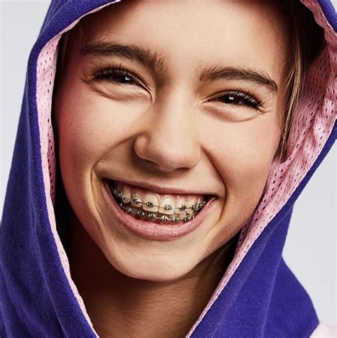 Pin On Braces