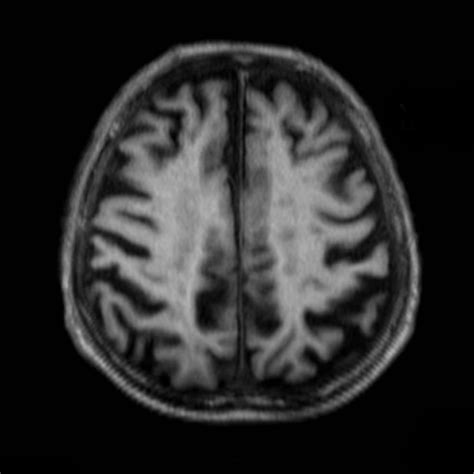 Alzheimer's disease MRI - wikidoc