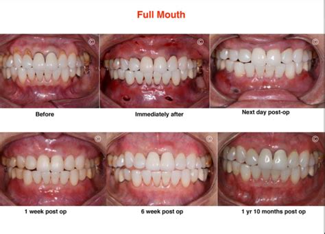 Pinhole Gum Rejuvenation® Dental Gum Restoration In Alhambra Ca