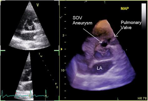 Echocardiography Of The Aortopulmonary Window Aorto Ventricular