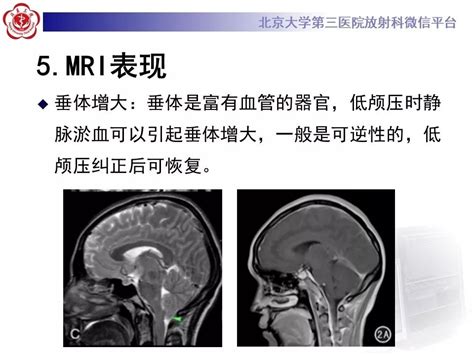 【ppt】低颅压综合征的mr影像 影像ppt