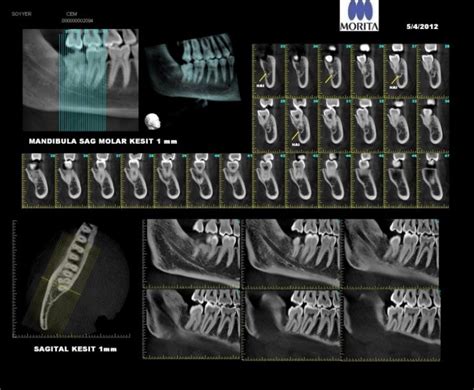 Cbct Scanning Endodontic Group