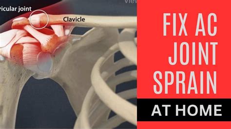 Fix Acromioclavicular Joint Acj Sprain At Home With Stretches And