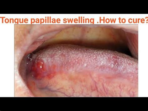 Tongue Papillae Enlargement Cure Of Pain Burning Itching Niddle Prick