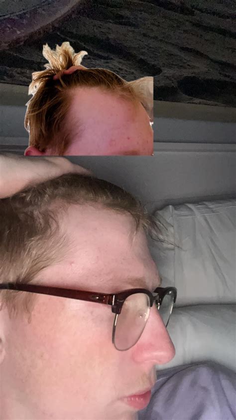 1 Mg Oral Finasteride And 5 Topical Minoxidil 4 Months Hairline Progress R Tressless