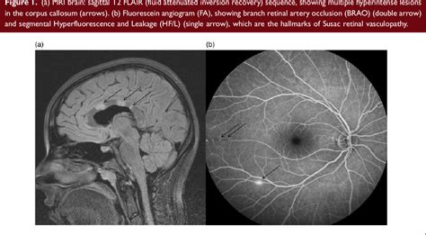 Figure 1 From Guidelines For Treatment Of Susac Syndrome An Update