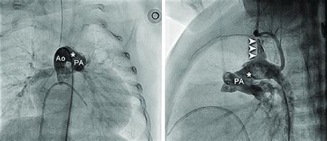 Cardiac Catheterization Panel A Anterior Posterior Projection A