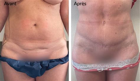 Cicatrices Apr S Abdominoplastie Comment Les Cacher Dr Haddad