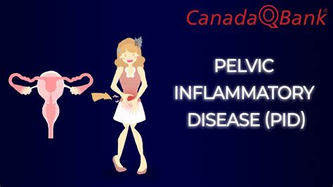 Pelvic Inflammatory Disease PID YouTube