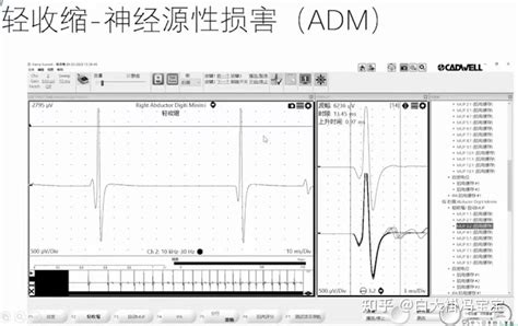 常规肌电图解读怎么入门？ 知乎