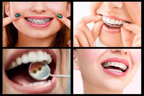 The Different Types Of Braces Creekside Dental Kennewick