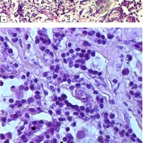 Case 2 Histologic Sample From Orbital Mass Hematoxylin And Eosin