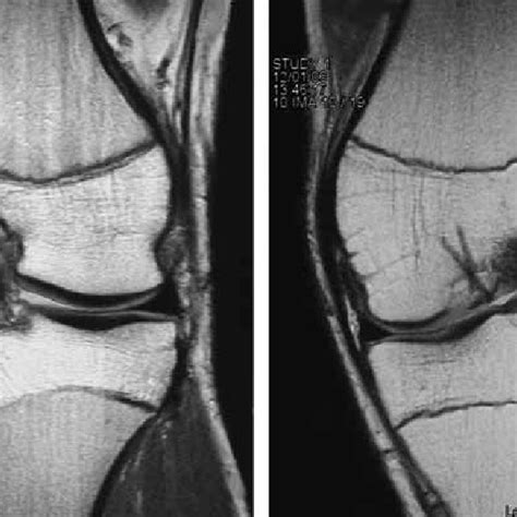 arthroscopic image   traumatic full thickness chondral defect