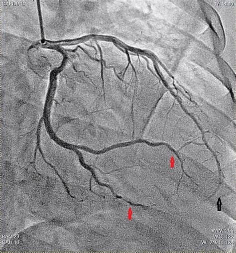 Multiple Distal Coronary Artery Thrombosis In Acute Myocardial