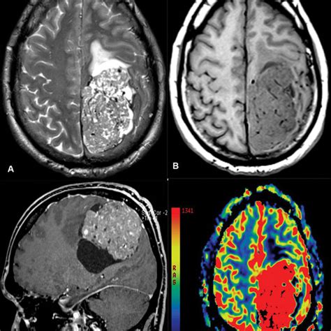 Axial T2 Weighted Axial T1 Weighted Precontrast And Sagittal