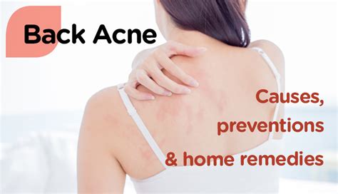 Back Acne Home Remedies Atelier Yuwa Ciao Jp