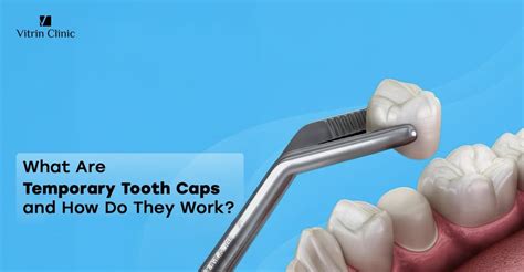 key steps   successful tooth cap procedure