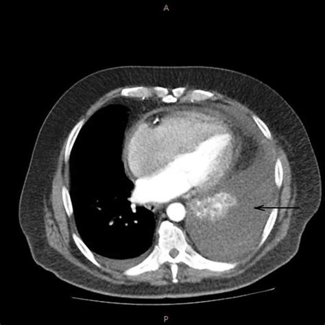 PDF Spontaneous Splenic Rupture Secondary To Rivaroxaban Rare But