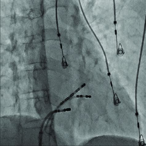 Ablation Catheter In Kochs Triangle Download Scientific Diagram