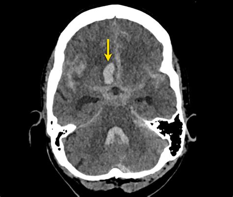 The Radiology Assistant Non Traumatic Intracranial Hemorrhage