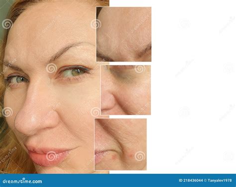 Woman Face Wrinkles Aging Before And After Treatment Collagefacelift