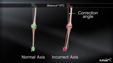 Arthrex IBalance HTO Implants And Anchors