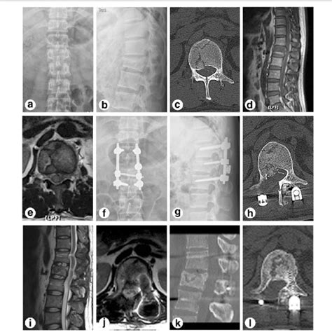 Preoperative Postoperative And A 3 Month Follow Up Radiographs Of A