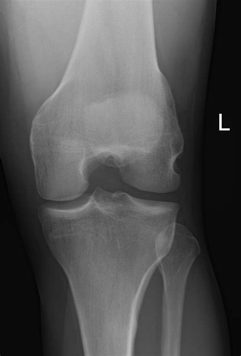 Osteochondral Knee Fracture Due To Pivot Shift Injury Image