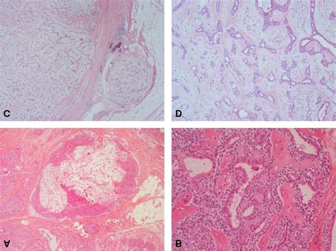 Microscopic Examination Of Chondroid Syringoma From Case 1 A And B