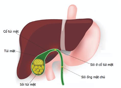 Những điều cần biết khi thực hiện mổ nội soi lấy sỏi túi mật