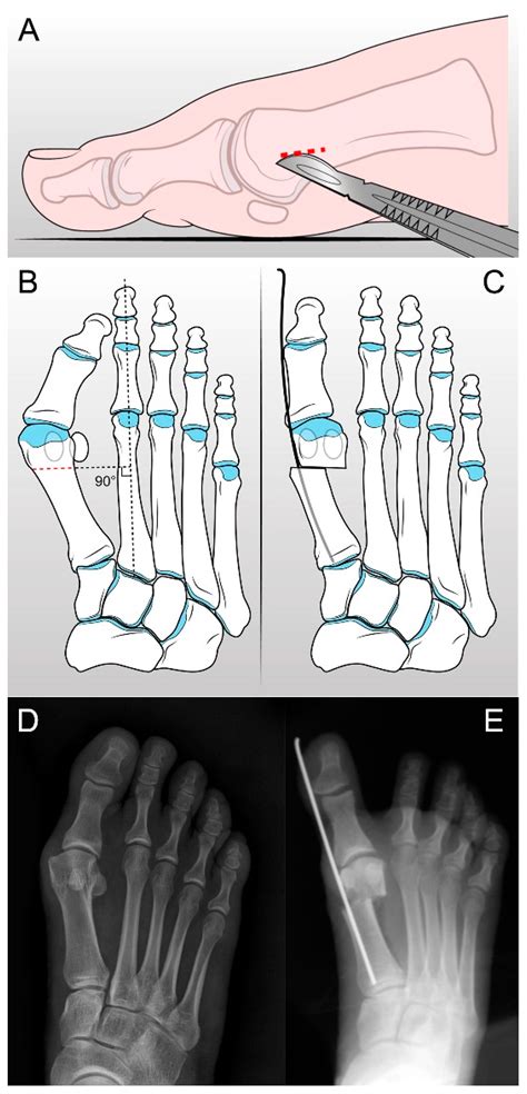 Hallux Valgus Plantar Pressure Distribution before and after a Distal