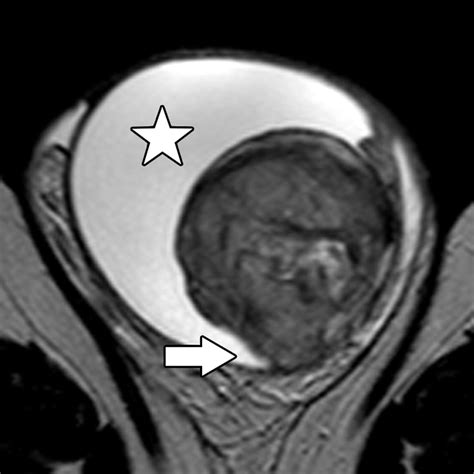 Mri In The Characterization And Local Staging Of Testicular Neoplasms Ajr