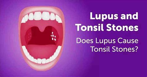 Discover Signs, Causes, Treatment, & Prevention Tonsil Stones