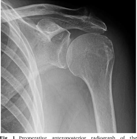 Figure From Subacromial Balloon Implantation For The Treatment Of