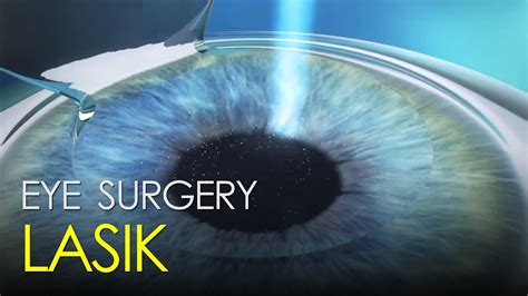 Lasik Eye Correction Surgery Youtube