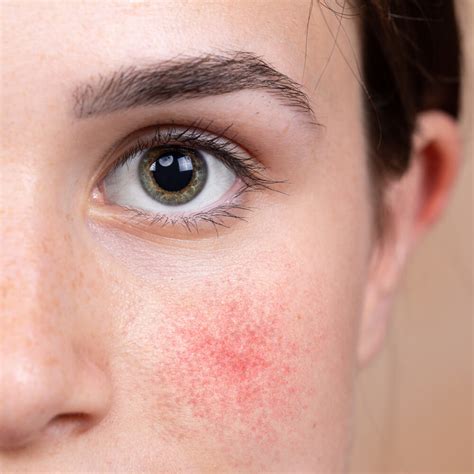 Treating Lupus Rash Vs Rosacea Curology