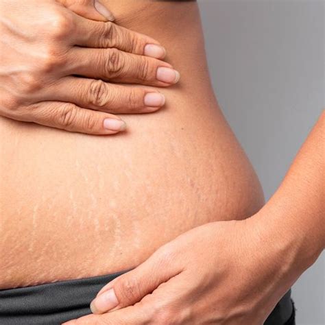 Stretch Marks In Teenagers Causes Prevention And Treatment