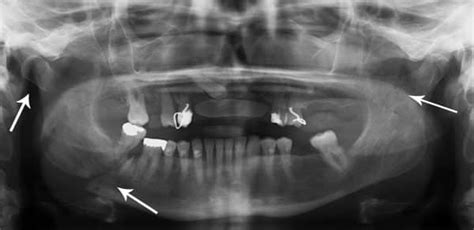 The Mandible Structure Attachments Fractures Teachmeanatomy