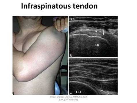 Diagnostic Ultrasound Of Shoulder Ppt