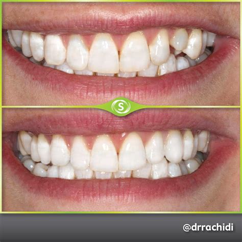 Dental Crowns Zirconia Dr Karim Rachidi • Synergy Dental Clinic