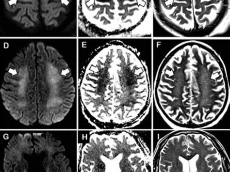 Leucoencefalopatia supratentorial isquémica de predomínio